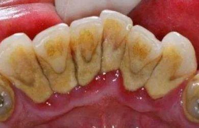 「洁牙」“牙结石”教你4个土办法，不用去洗牙，牙垢哗哗往下掉