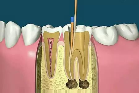 |全国爱牙日：牙疼快速止疼偏方，只有这个办法才是真的好使