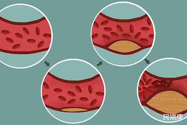 『』睡觉时，身体总有异样发生，不可大意，多半是体内有血栓