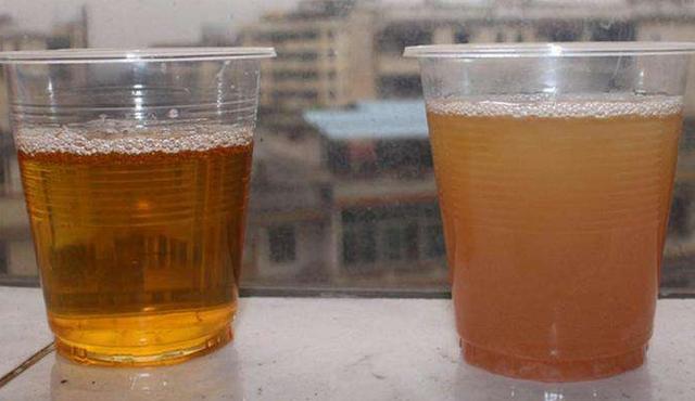 医生▲尿液是肾功能的“试金石”，不同颜色的尿液，究竟意味着什么？