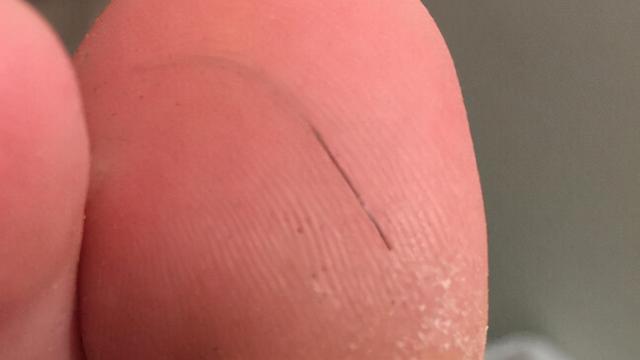 英国英鸟|奇！大马男孩脚痛难忍，医生竟在脚里找出根头发，拔掉后药到病除