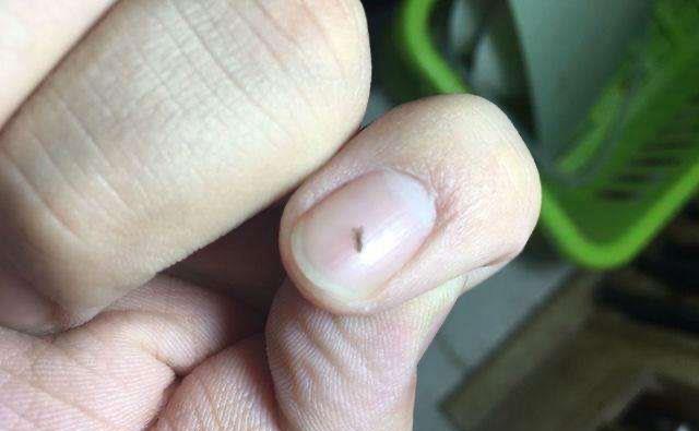 |为何30年前男女老少都有虱子,现在没有了?虱子是哪里来的?