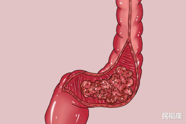 糖尿病|尿酸久升不降，当心拖成肾衰竭！医生：戒掉三个坏习惯，养护肾脏