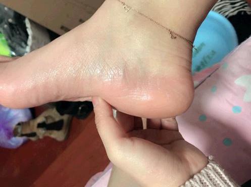 #皮肤干燥#女人脚裂会留下什么痕迹？医生：3点变化一眼看穿，骗不下去