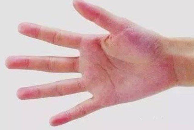 肝脏|肝变硬时，身体或会出现4个现象，若一个没有，很值得恭喜