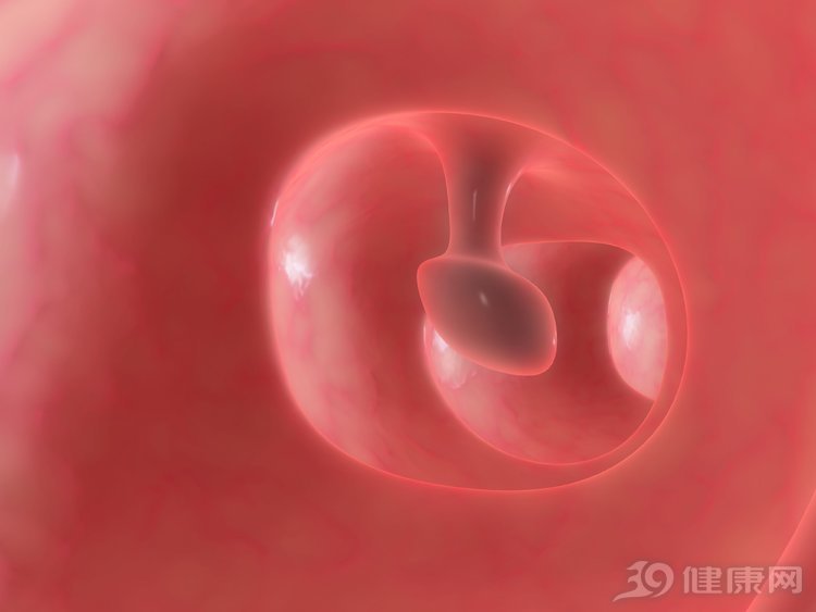 肠息肉▲忠告:2个部位的息肉最好及时切除,别为癌症“留后路”!