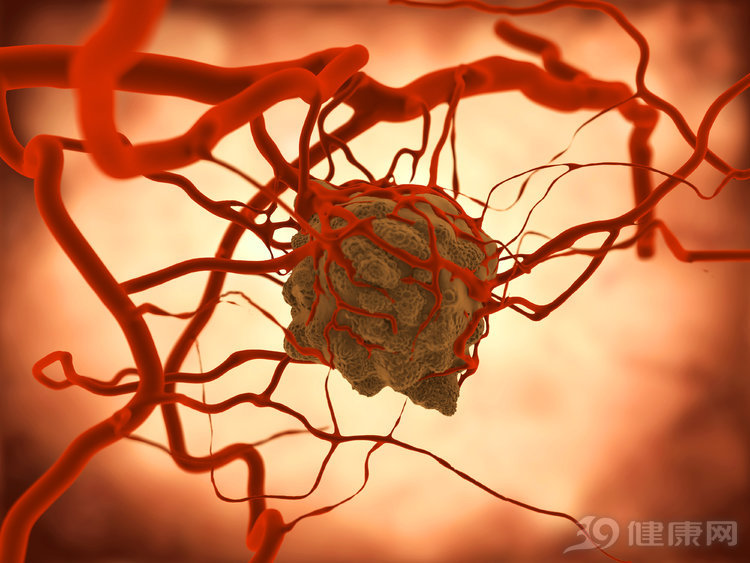 肿瘤|为什么肿瘤切除后很快就转移了，是没有切干净？医生说出原因