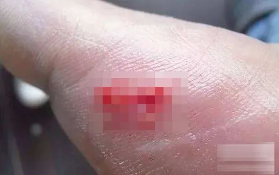 中山▲中山男子爬横琴山被竹叶青咬中！做这个错误动作，引蛇二度攻击！