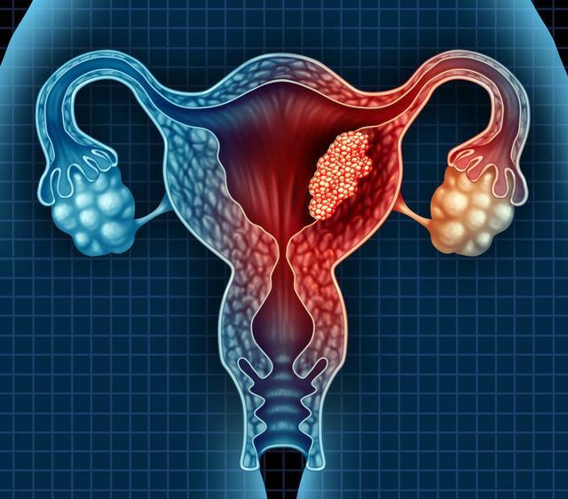 #宫颈癌#32岁女高管确诊宫颈癌，大夫告知真相，丈夫直接将妻子打翻在地！