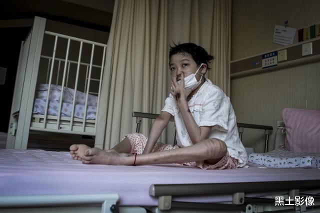 小姐姐▲湖北9岁女孩肺部“薄如纸片”体重仅有22公斤,胳膊腿瘦如柴火棍