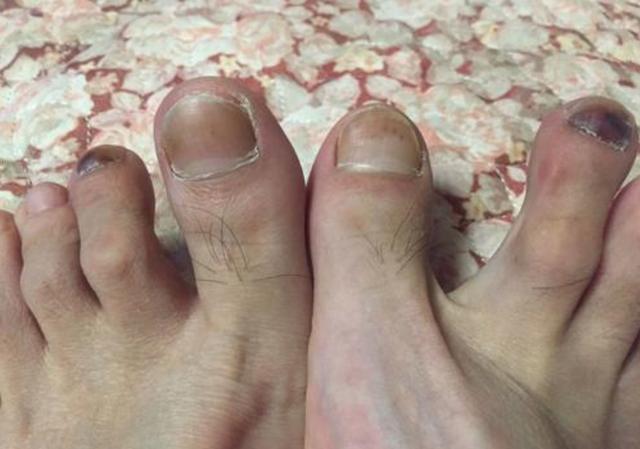 肝脏|肝脏很差的人，脚上往往有3个表现！希望你一个也没有