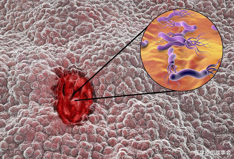 #胃癌#幽门螺杆菌其实并不可怕，医生提醒，只要做好三点，可以预防胃癌