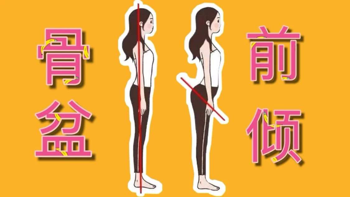 臀部|你的臀部是真翘，还是骨盆前倾？这个问题值得重视！