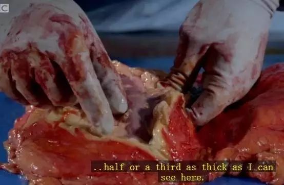 心脏|BBC解剖了一个200斤女子，看完你会用生命去减肥！