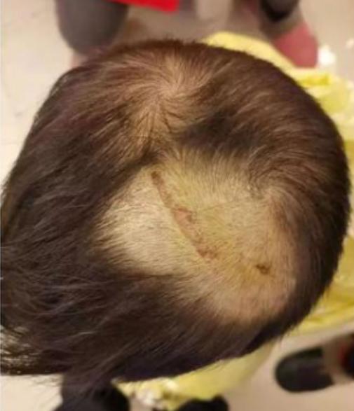 近40斤重抹灰层脱落，砸伤2人，装修公司认为并没有责任！