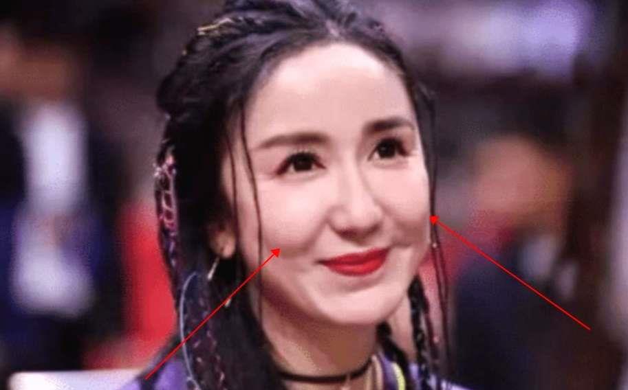 整容|她年仅31岁脸就塌了？一直不承认整容，现在满脸玻尿酸像“假人”