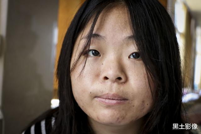 黑土影像|河南一24岁女孩患重症15年，期间父母相继离世，如今病房里只剩她