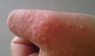 「糖尿病」身体血糖偏高，看手也能知道，若频繁出现4个表现，多半就是了