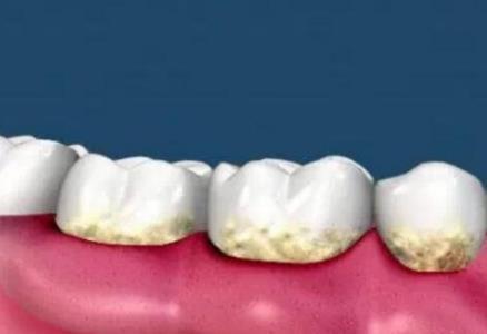 「肝脏」牙齿长出“小石头”，教你一个土方法祛除，不用花钱去洗牙