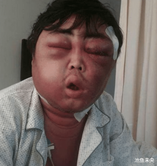 #脱发#肾功能“弱”的男人，头部“3异象”贼显眼，但愿你一个不占！