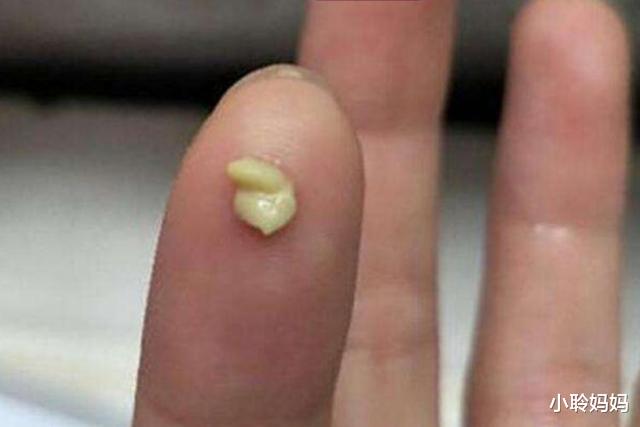 口臭|儿子被同学嫌弃口臭,送医检查后,取出“一臭物”让医生都干呕