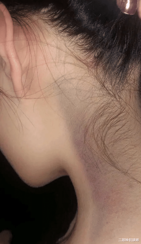 |“女子睡一觉醒来后脖子青了一块，怎么回事？”哈哈哈来我家治