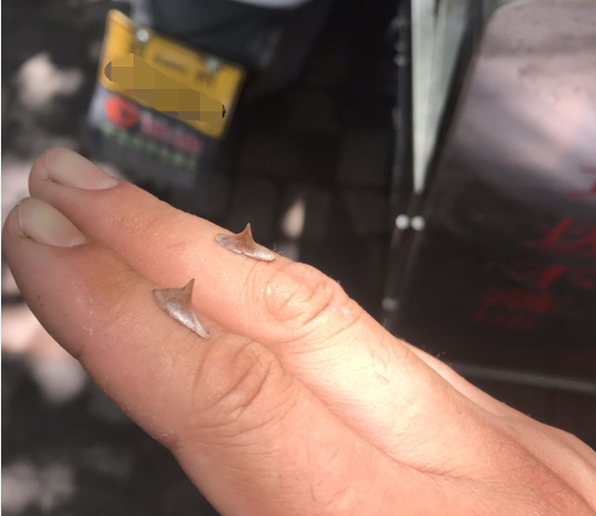 「」“手上长了两根刺,一碰就疼怎么办?”哈哈哈建议你去看神经科!