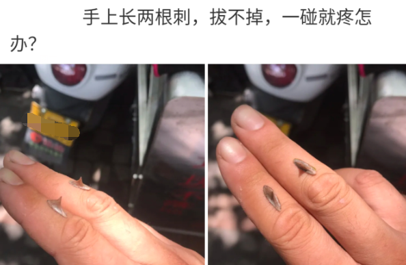 「」“手上长了两根刺,一碰就疼怎么办?”哈哈哈建议你去看神经科!