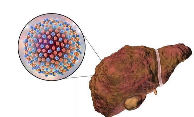 医生|肝癌疼痛是左肩还是右肩？