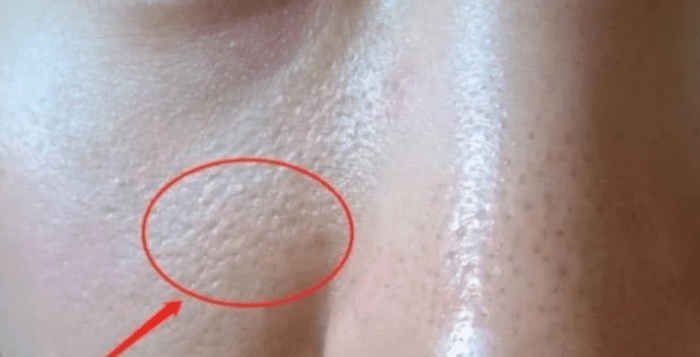 排毒|当肝功能下降会反射在脸上的几种情况，一个没有，恭喜肝很健康！