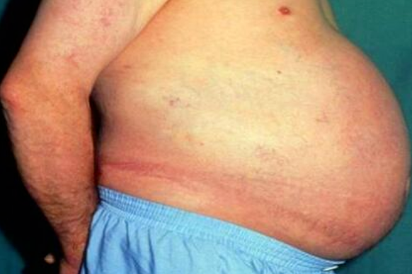 便秘|史上第一个被憋死的人：便秘三年，去世后尸检肠内大便重36斤