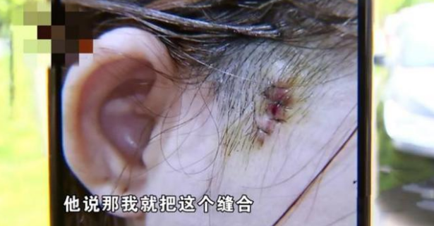 医美|美容院老板娘做完“线雕”后，鬓角突然多了个洞？维权还困难重重