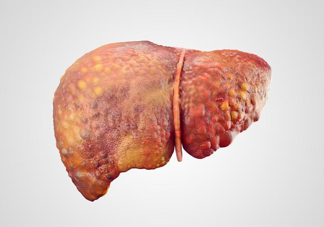 肝癌|42岁男子，确诊肝癌入院，提醒：身上若有\2红、3黄\，早查肝CT