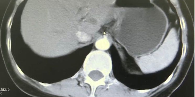 「」女老师胃痛半年,检查一看吓坏,医生:胃已经跑到胸腔了