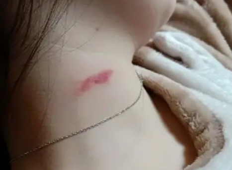 「肾病」“医生说消肿才给拔，半夜起来我就给拔了”结果评论区炸锅了哈哈哈