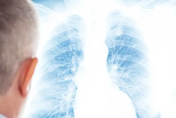 肺癌：俄罗斯小伙被确诊为肺癌，手术时，医生在其肺中发现一棵冷杉树