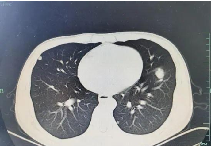 『肝癌』25岁男肚子痛一个多月,一查是肝癌晚期,医生:感染或许已有25年