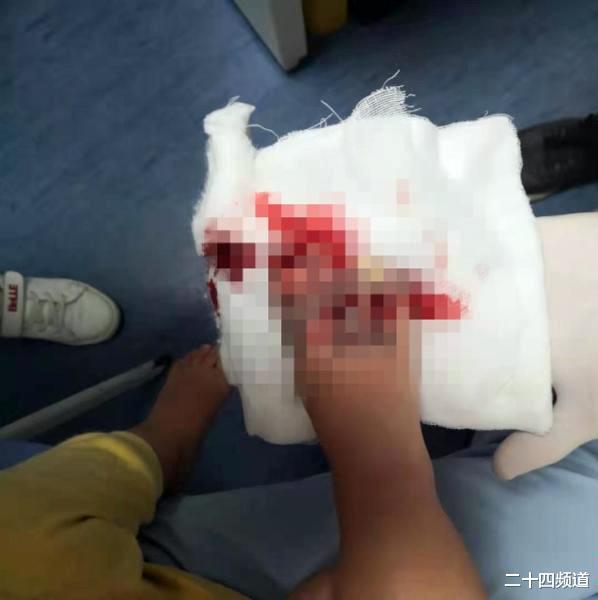 二十四频道 男童被商场扶梯夹断脚趾，才21个月大，家长索赔：有警示标志但不醒目