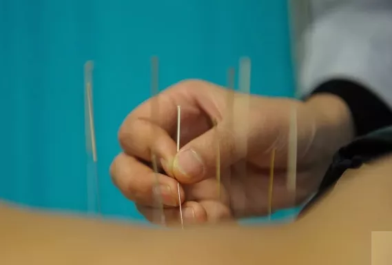 针灸|针灸好处虽多，但这五类人并不适合......