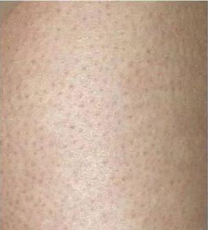 黑头|闭口、黑头、痘痘、脂肪粒……终于分清它们是什么了