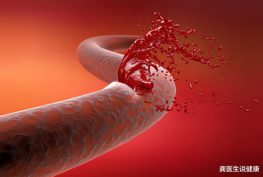 食管癌|冬季将至，高血压患者需警惕4种表现，医生：小心是脑出血的前兆