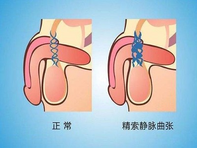张广清谈男题|小心这些小蚯蚓，精索静脉曲张发病率高达10%，还会引起不育？