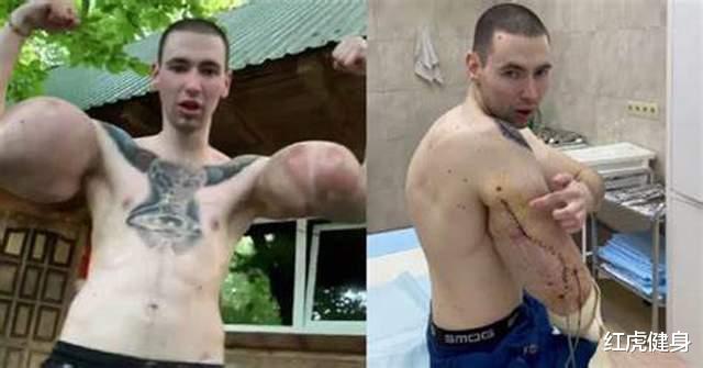 俄罗斯|“俄罗斯大力水手”，61厘米手臂面临手术，否则将有截肢风险