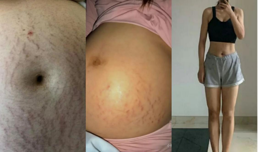 fashion美尚|十个妈妈九个长?孕期被妊娠纹格外“偏爱”拿什么来拯救我的肚皮