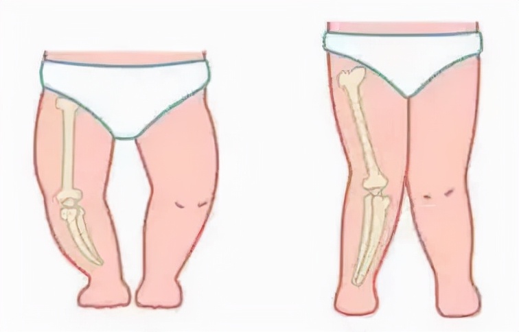 中康之家 怎么判断孩子是O、X型腿？