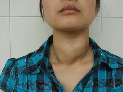 金兰中医学社|常喝小米粥能养甲状腺？医生：不想甲状腺“报废”，2种粗粮要少吃