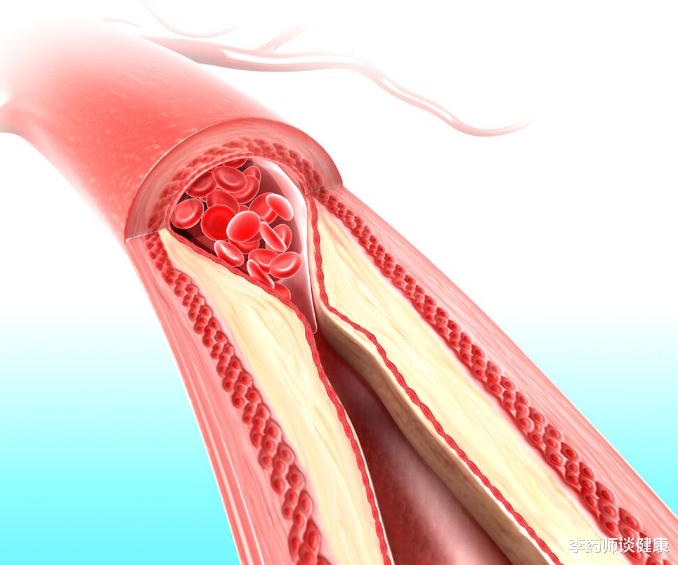 李药师谈健康|高尿酸也是心血管风险因素，该降到多少？如何用药？专家共识来了