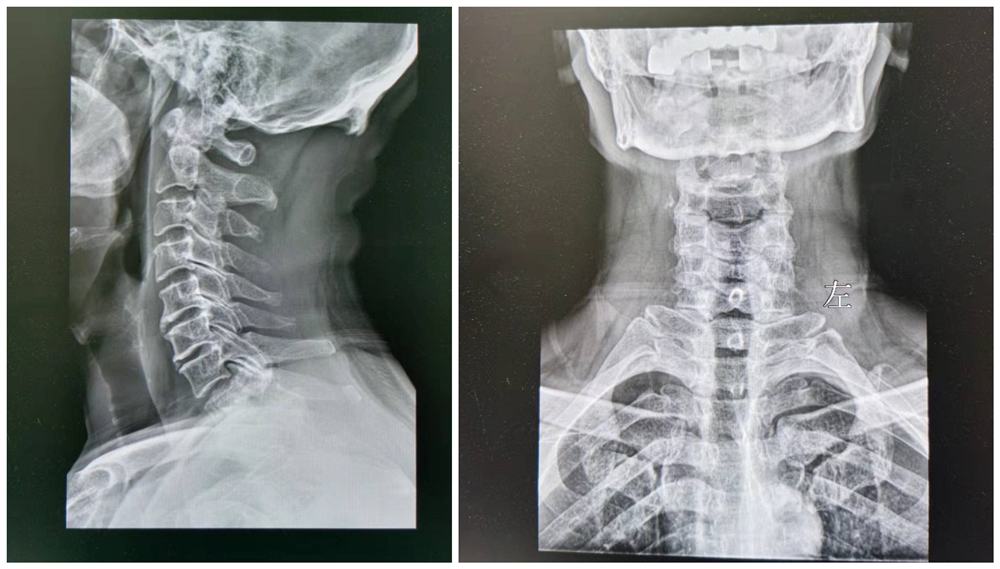 高血压|29岁颈源性高血压患者!低龄化发病人群该如何注意身体