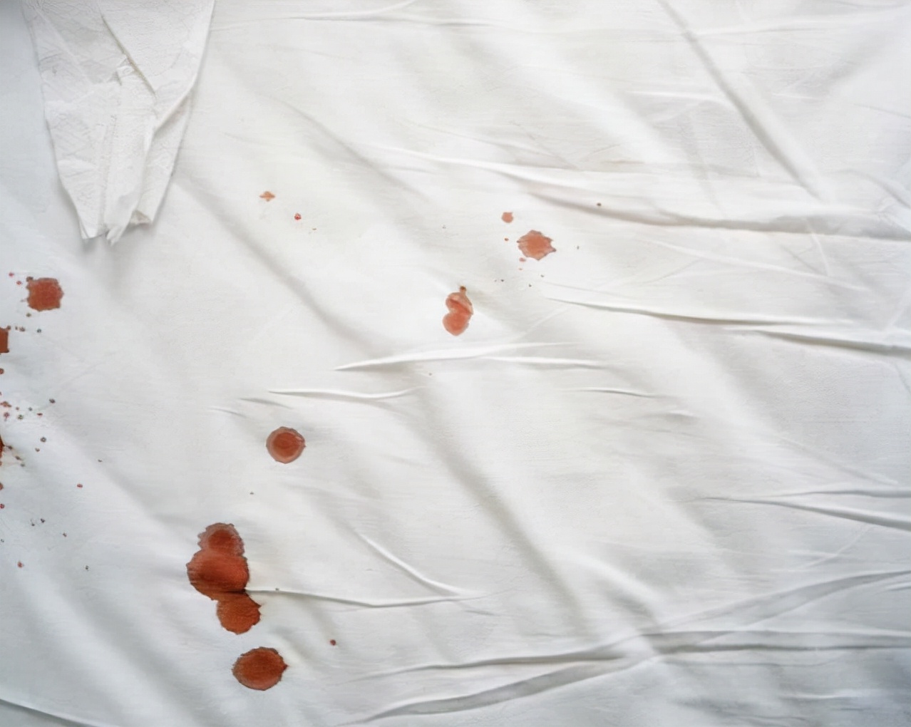 医生|37女子意外染上HPV,2个月后疣体满脸,医生感叹:一定要重视,晚了毁容