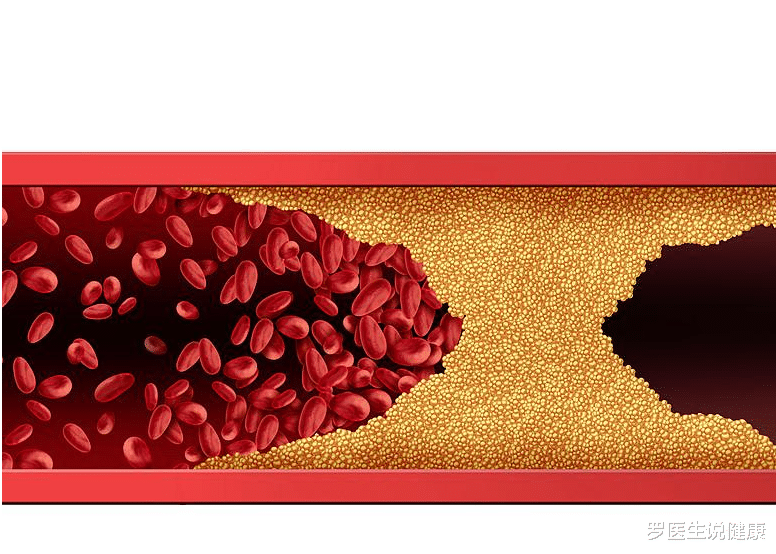脑梗|血管“刮油机”已公布,不是海带,平时敞开吃,给血管“瘦瘦身”,脑梗远离你
